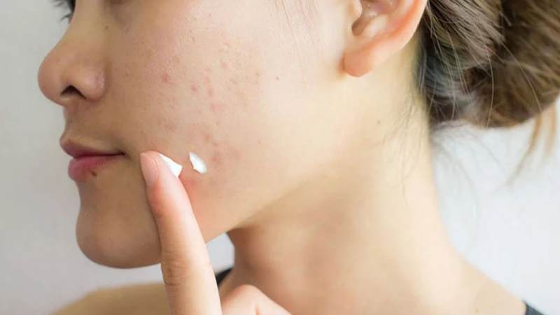 Chấm mụn là phương pháp sử dụng sản phẩm thuốc bôi vào các nốt mụn 