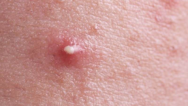 Làm vỡ mụn mủ khiến da cần thời gian chữa lành và để lại sẹo