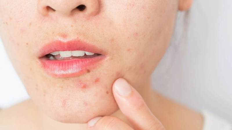 Chạm tay bẩn lên da khi nặn mụn có thể làm chậm quá trình chữa lành và dẫn đến sẹo mụn