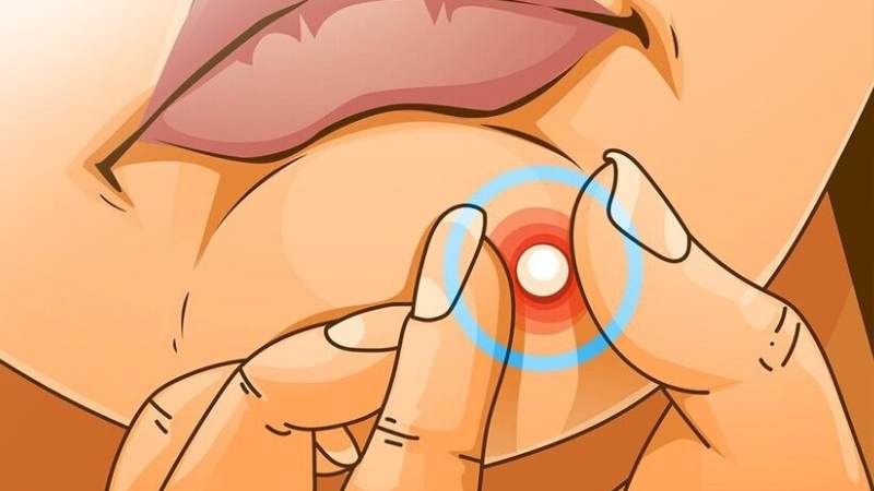 Nặn dịch mủ có thể gây ra phản ứng viêm khiến nốt mụn vừa nặn bị sẹo rỗ sau mụn