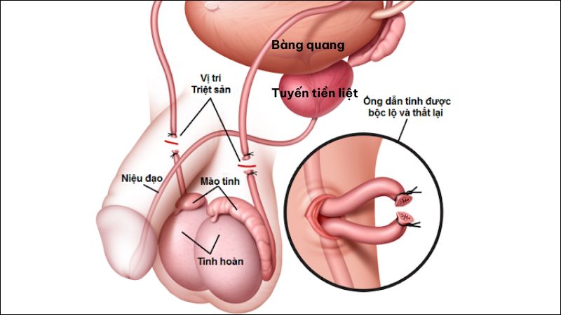 Thắt ống dẫn tinh là một biện pháp tránh thai hiệu quả dành cho nam giới