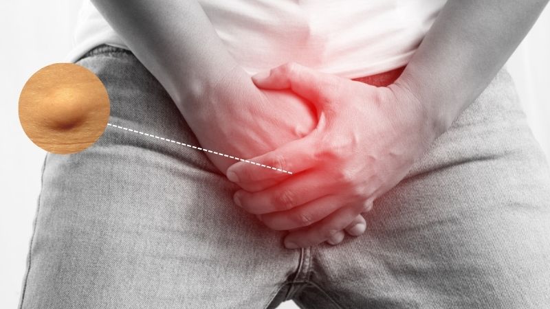 Hạch bẹn c&oacute; thể xuất hiện một b&ecirc;n hoặc cả hai b&ecirc;n bẹn