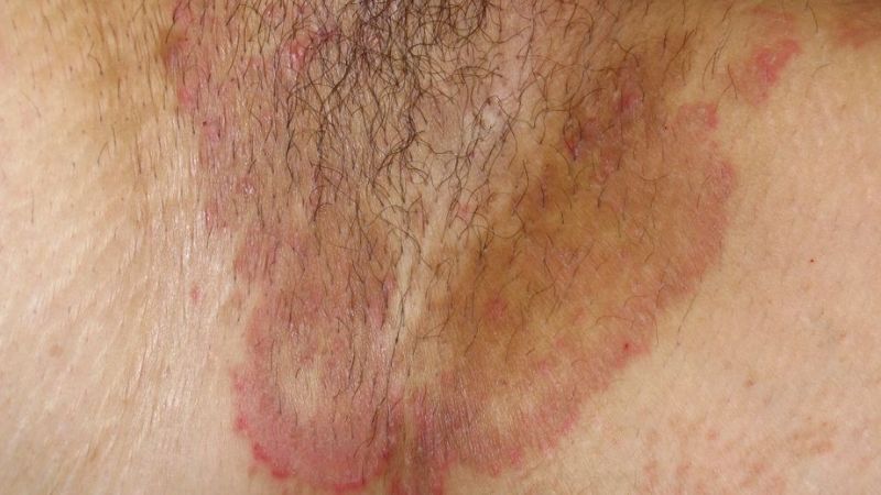 Nhiễm nấm ở v&ugrave;ng bẹn c&oacute; thể g&acirc;y ra hạch bẹn
