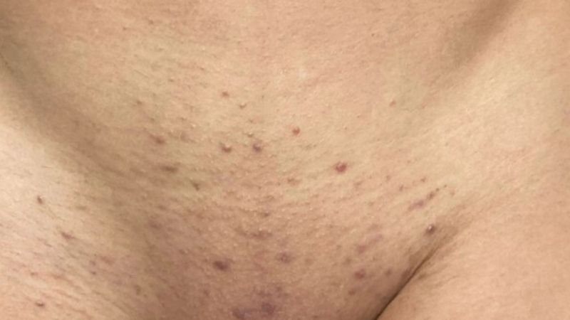 Cơ thể c&oacute; thể phản ứng l&agrave;m sưng hạch bẹn khi bị vi&ecirc;m nang l&ocirc;ng