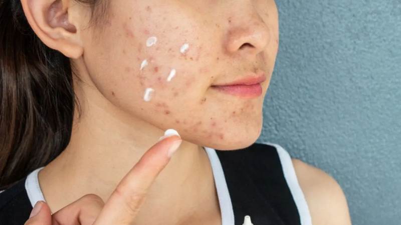 Bôi kem trị mụn vào ban đêm trước bước serum và kem dưỡng ẩm
