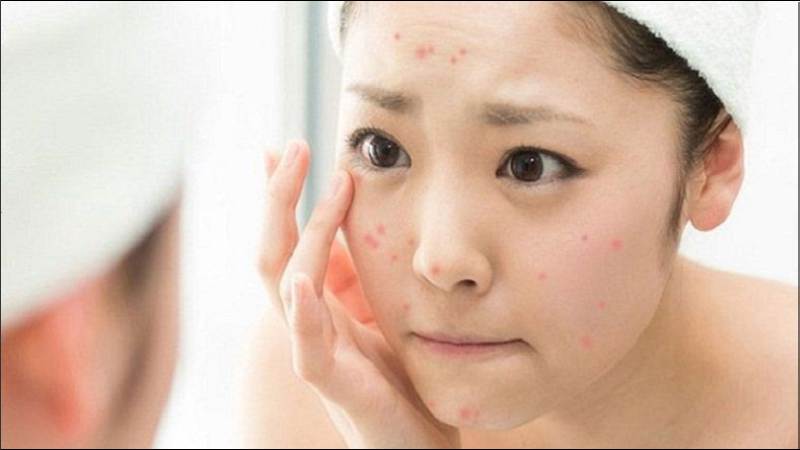 Chăm sóc da bị mụn cần tìm kiếm quy trình chăm sóc phù hợp