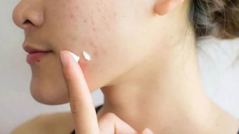 Hãy lựa chọn các sản phẩm trị mụn phù hợp với loại da và loại mụn