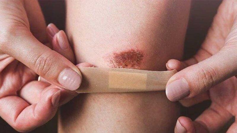 Cúc la mã làm rút ngắn thời gian làm lành vết thương