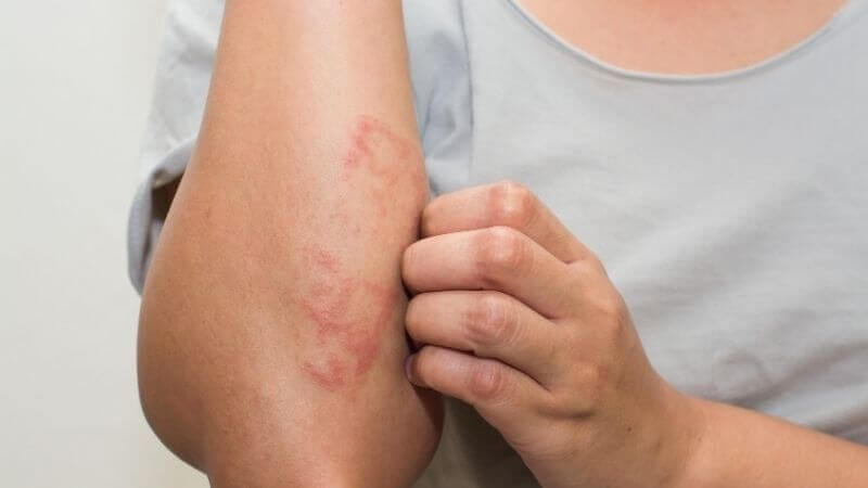 Cúc la mã được sử dụng để hỗ trợ điều trị bệnh chàm