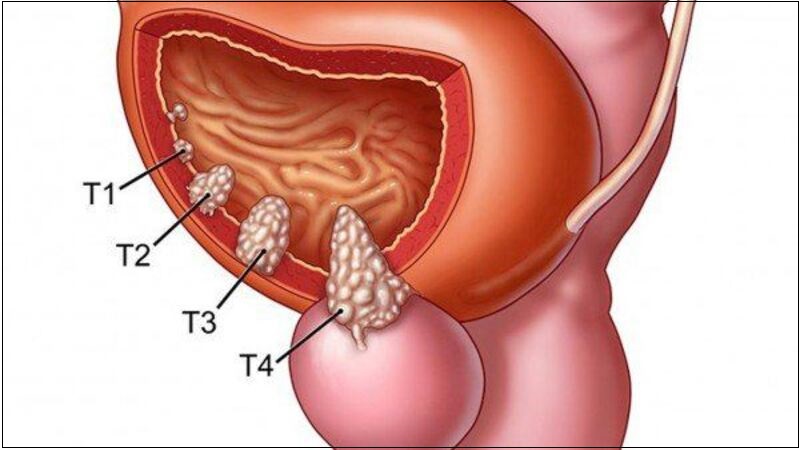 Bổ sung vitamin E liều cao có thể làm tăng nguy cơ mắc ung thư tuyến tiền liệt ở nam giới