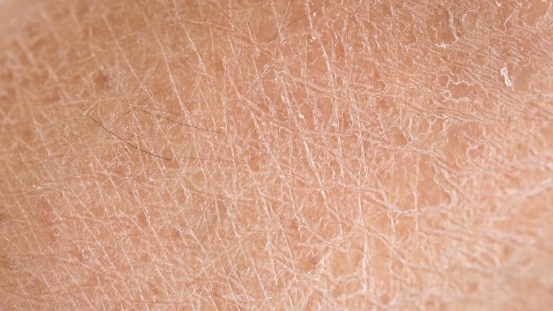 Thiếu vitamin E có thể dẫn đến tình trạng da khô và nứt nẻ