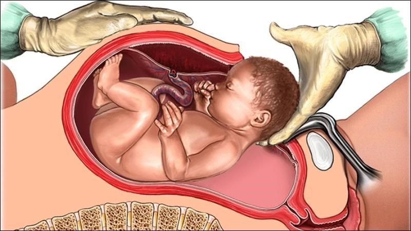 Bé có mẹ mắc tiểu đường thai kỳ có nhiều nguy cơ thai to