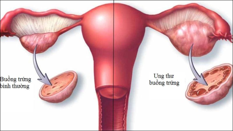 Các nghiên cứu cho thấy nước ép dứa giúp giảm nguy cơ mắc ung thư buồng trứng
