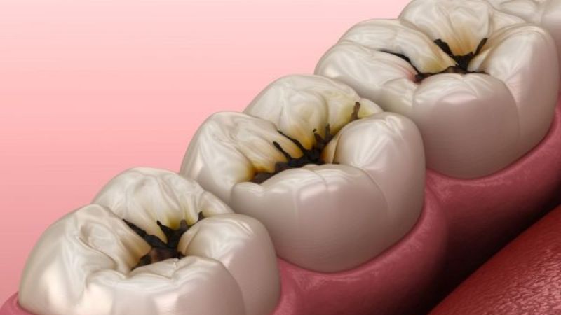 Nước ép dứa có thể làm hỏng men răng và dẫn đến sâu răng