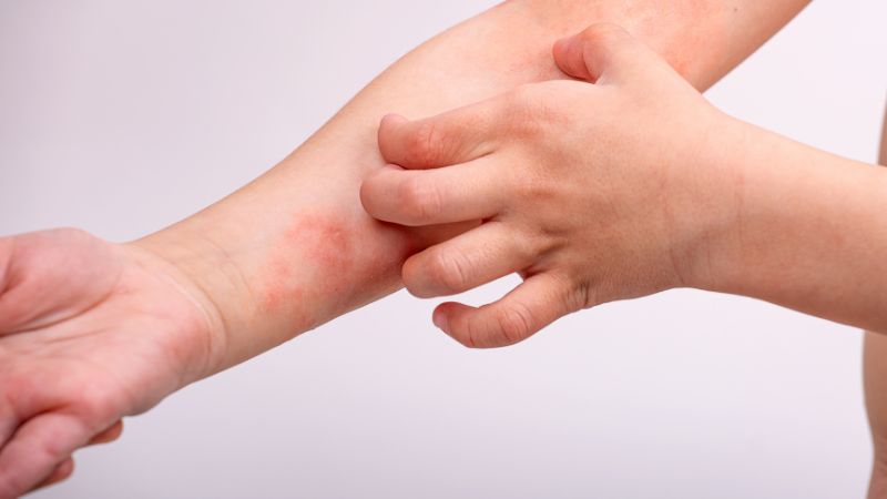 Sử dụng lá đinh lăng để đắp ngoài da giúp làm dịu những kích ứng 