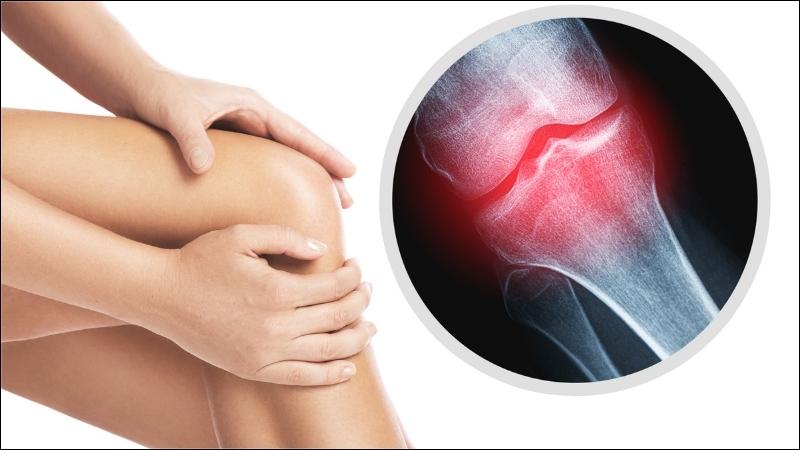 Suy thận mạn sẽ l&agrave;m yếu xương v&agrave; l&agrave;m tăng nguy cơ g&atilde;y xương 