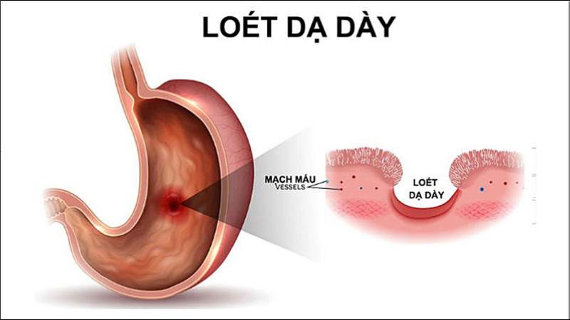 Loét dạ dày là tác dụng phụ có thể gặp khi uống nước chanh quá nhiều