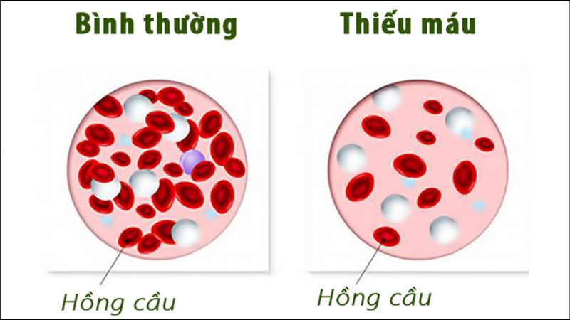 Nước chanh giúp cơ thể hấp thụ nhiều sắt hơn từ chế độ ăn uống, ngăn ngừa bệnh thiếu máu