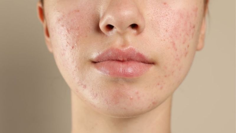 Tinh dầu thông đỏ có thể giúp điều trị một số bệnh ngoài da như mụn trứng cá và bệnh chàm