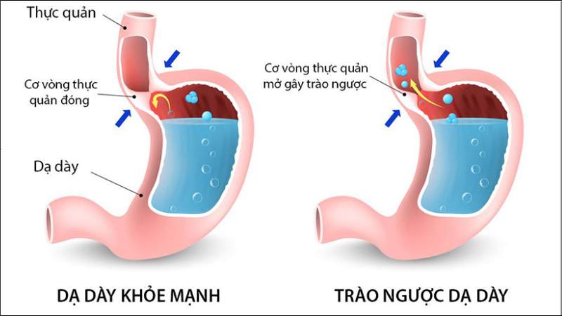 Tiêu thụ nhiều nước cam có thể làm trầm trọng hơn triệu chứng của bệnh trào ngược dạ dày thực quản