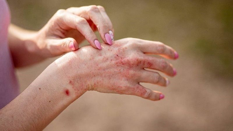 Người bị dị ứng với trà atiso không nên sử dụng để tránh gây hại cho sức khỏe