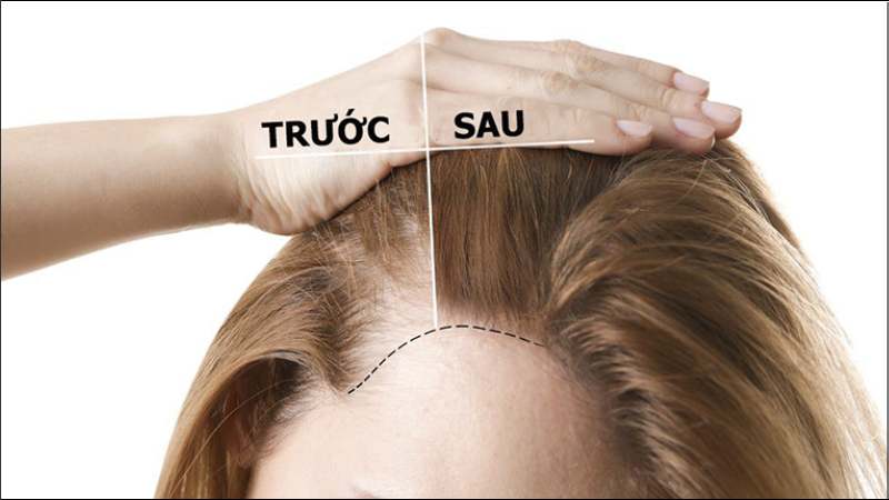 Dầu dừa có thể kích thích giúp tóc mọc nhanh hơn