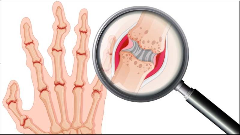 Cây cỏ sữa lá nhỏ là một trong những thực vật giúp điều trị viêm khớp dạng thấp