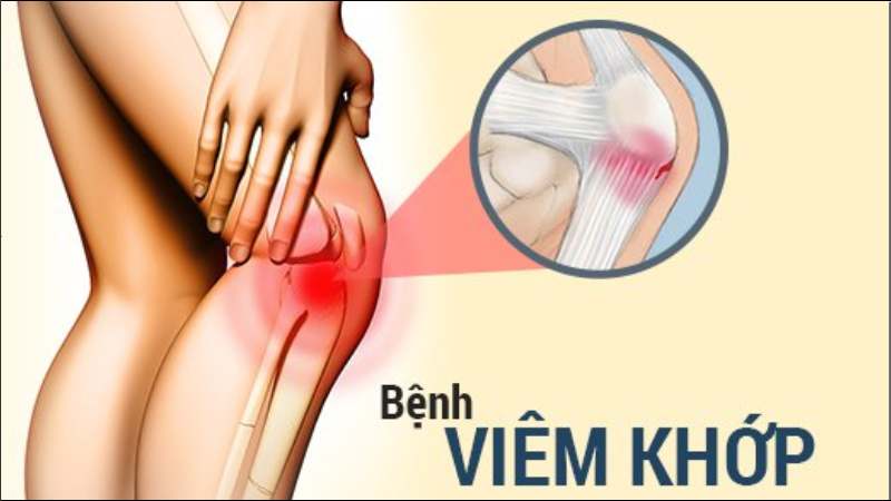 Kombucha chứa nhiều chất chống oxy hóa và polyphenol giúp giảm viêm khớp
