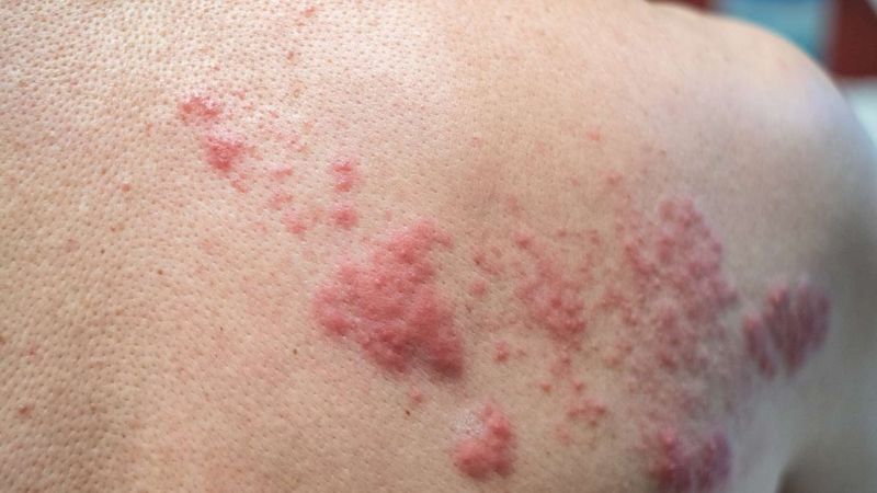 Triệu chứng điển hình của zona thần kinh là các nốt phỏng nước kèm đau rát, dọc theo hệ thống dây thần kinh.