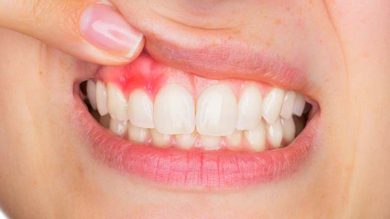 Nhai sống trực tiếp lá dứa giúp trị đau nhức răng, viêm nướu