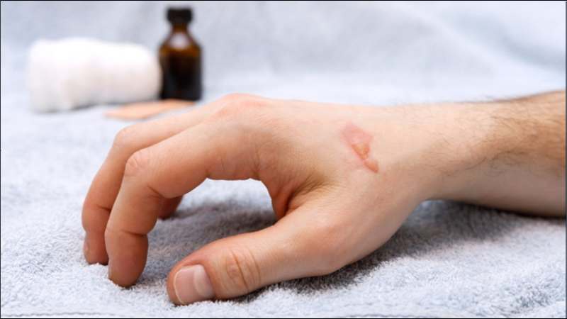 Đắp lá dứa khô nghiền nát ngoài da giúp điều trị bỏng nhẹ