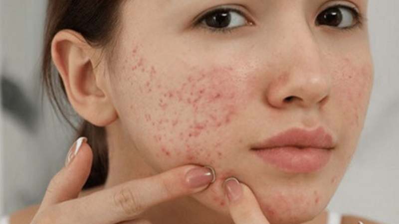 Tiêu thụ kẽm gluconate đường uống làm giảm bớt các triệu chứng của mụn trứng cá