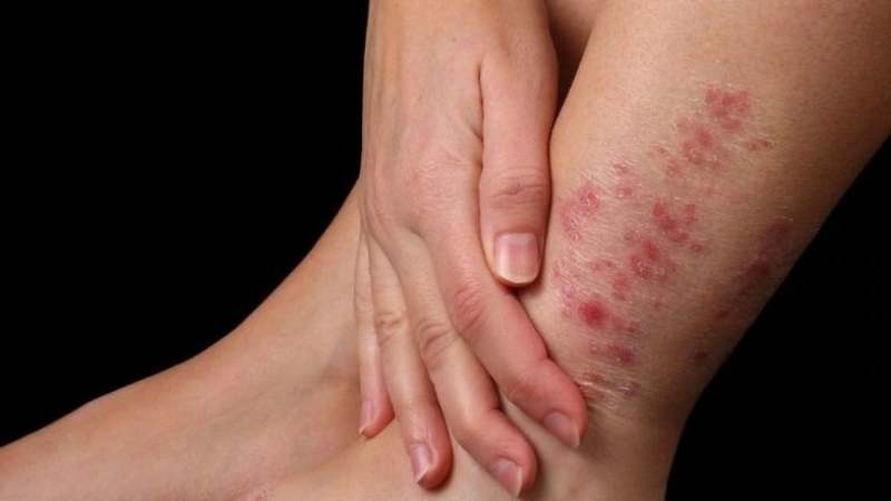 Sử dụng kẽm đường uống có hiệu quả trong việc kiểm soát các phản ứng của bệnh phong