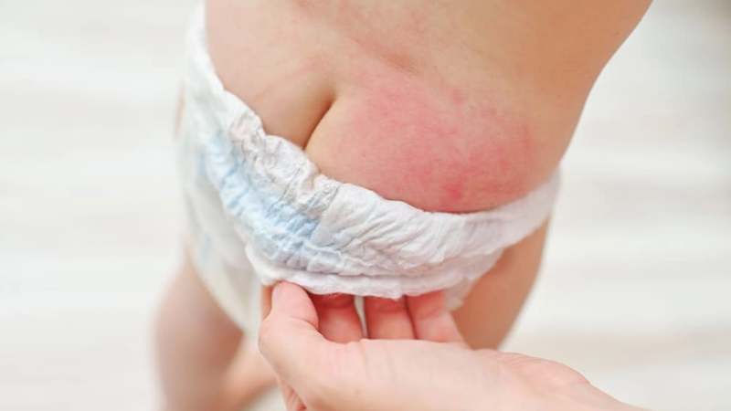 Sử dụng thuốc mỡ chứa 5% kẽm oxit giúp ngăn ngừa chứng hăm tã
