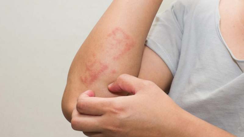 Kẽm kết hợp với axit undecylenic giúp điều trị bệnh nấm da