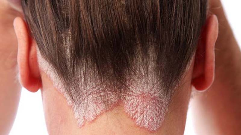 Sử dụng kem bôi chứa 0,25% kẽm pyrithione 2 lần/ngày có hiệu quả đối với bệnh vảy nến