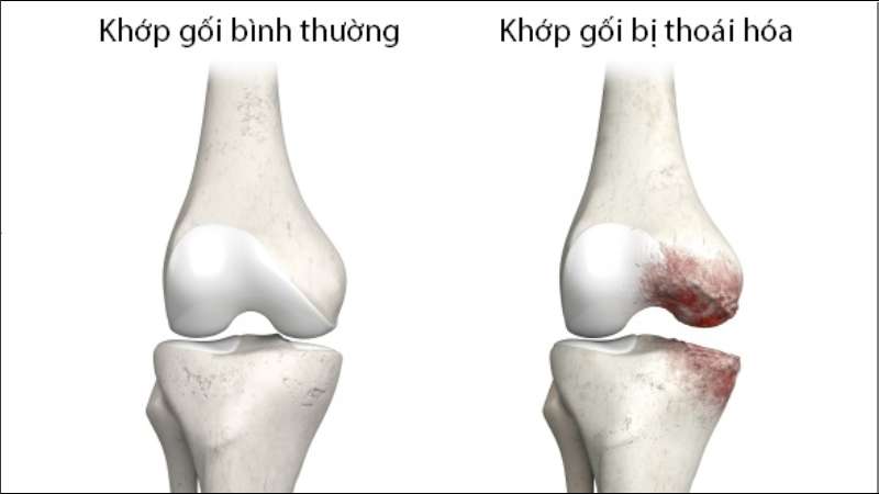 Tư thế gác chân lên tường giúp bảo vệ cột sống và phòng ngừa thoái hóa khớp