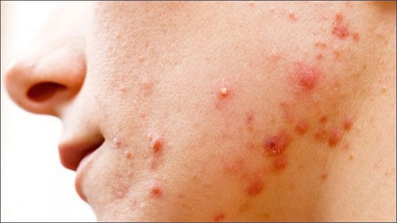 Axit salicylic thấm sâu vào lỗ chân lông chứa dầu, loại bỏ bã nhờn và tế bào chết, hỗ trợ điều trị hiệu quả các loại mụn trứng cá Axit salicylic thấm sâu vào lỗ chân lông chứa dầu, loại bỏ bã nhờn và tế bào chết, hỗ trợ điều trị hiệu quả các loại mụn trứng cá