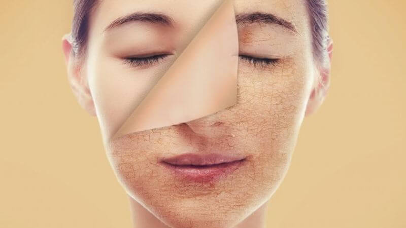 Với khả năng tan trong dầu, axit salicylic thâm nhập sâu vào lỗ chân lông, loại bỏ bã nhờn và tế bào chết Với khả năng tan trong dầu, axit salicylic thâm nhập sâu vào lỗ chân lông, loại bỏ bã nhờn và tế bào chết