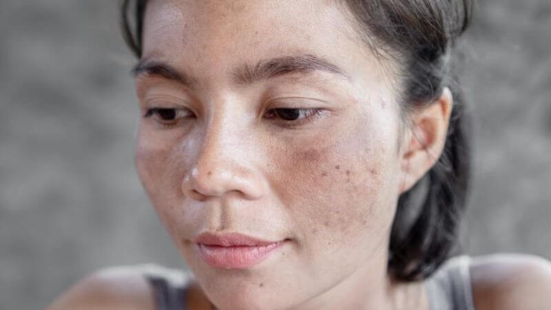 Axit salicylic (BHA) và axit glycolic (AHA) thường được sử dụng trong các liệu trình tẩy da chuyên sâu để cải thiện tình trạng nám Axit salicylic (BHA) và axit glycolic (AHA) thường được sử dụng trong các liệu trình tẩy da chuyên sâu để cải thiện tình trạng nám