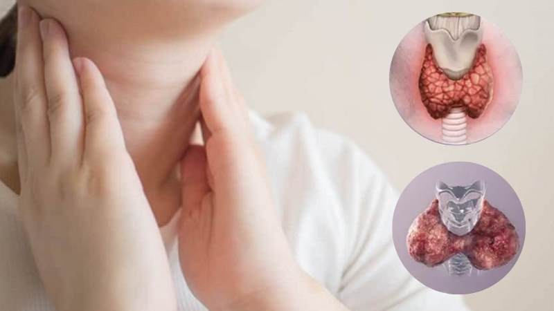Cường giáp và suy giáp khác nhau về lượng hormone giáp mà cơ thể sản xuất 