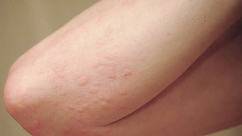 Những người bị dị ứng với sữa không nên tiêu thụ sữa non từ bò