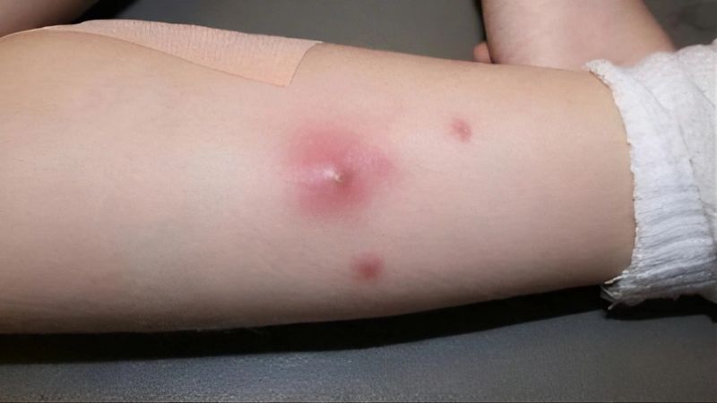 Muối hồng làm dịu vết côn trùng cắn