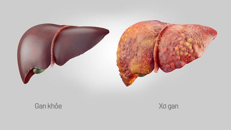 Uống bài thuốc có chứa điền thất giúp hỗ trợ điều trị xơ gan
