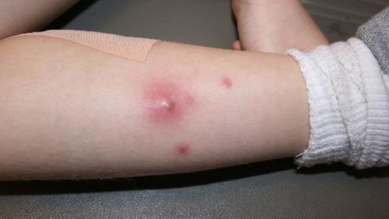 Cây và củ điền thất tươi giã ra lấy nước và bã dùng trong trị mụn nhọt