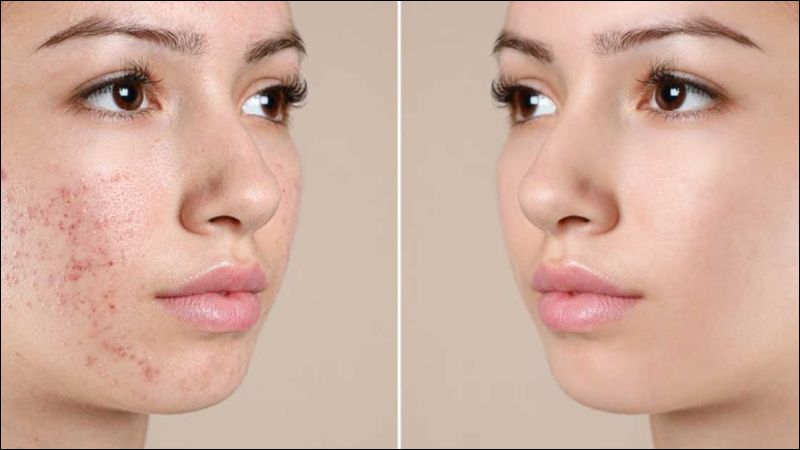 Nếu da bạn bị mụn hoặc kích ứng thì bạn nên chọn serum chứa niacinamide