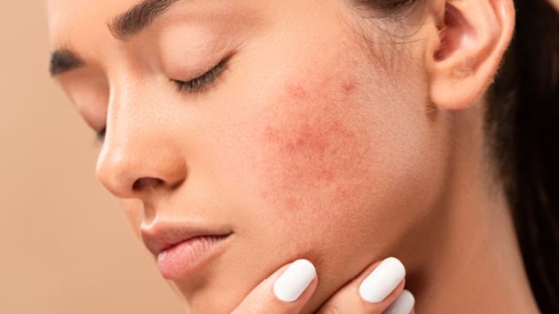 Chọn serum không đúng với nhu cầu và loại da có thể gây kích ứng da