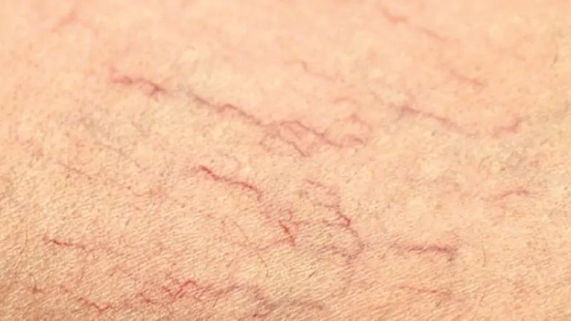 Thoa kem chống nắng hàng ngày giúp hạn chế giãn mạch máu Thoa kem chống nắng hàng ngày giúp hạn chế giãn mạch máu
