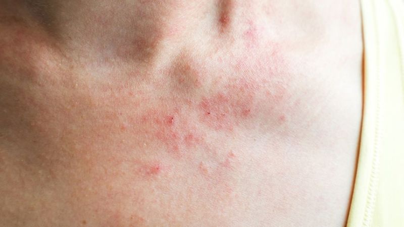 Kem chống nắng giảm viêm da bằng cách hạn chế tác động của các tia UV gây hại Kem chống nắng giảm viêm da bằng cách hạn chế tác động của các tia UV gây hại