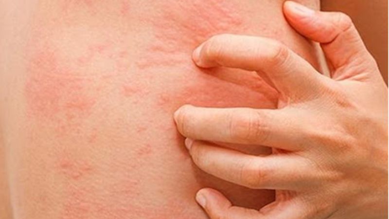 Một số thành phần trong kem chống nắng có thể khiến bạn bị dị ứng Một số thành phần trong kem chống nắng có thể khiến bạn bị dị ứng